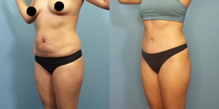 Before & After Liposuction Case 284 Left Oblique View in Portland, OR