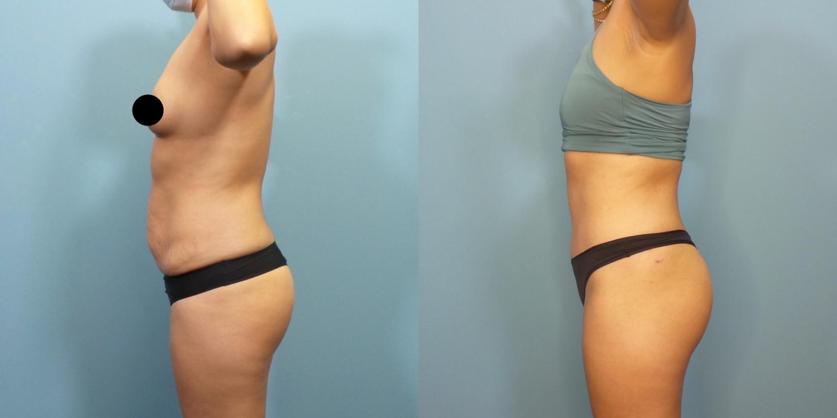 Before & After Tummy Tuck (Abdominoplasty) Case 284 Left Side View in Portland, OR