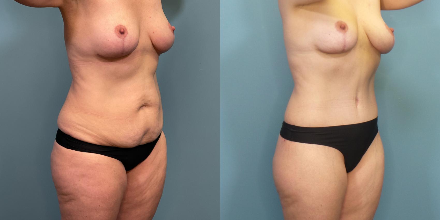 Before & After Massive Weight Loss/Body Lift Case 288 Right Oblique View in Portland, OR