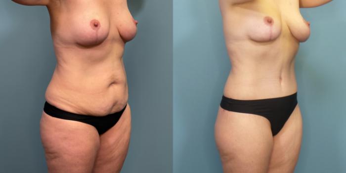 Before & After Tummy Tuck (Abdominoplasty) Case 288 Right Oblique View in Portland, OR
