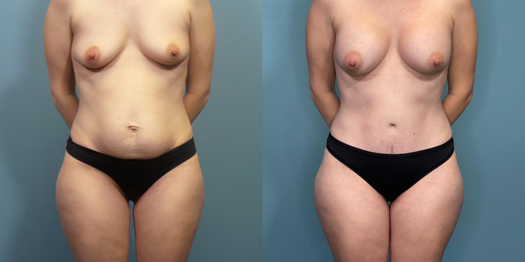 Before & After Tummy Tuck (Abdominoplasty) Case 289 Front View in Portland, OR