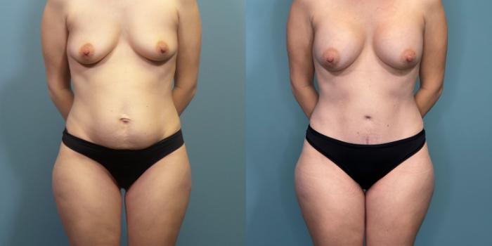 Before & After Tummy Tuck (Abdominoplasty) Case 289 Front View in Portland, OR