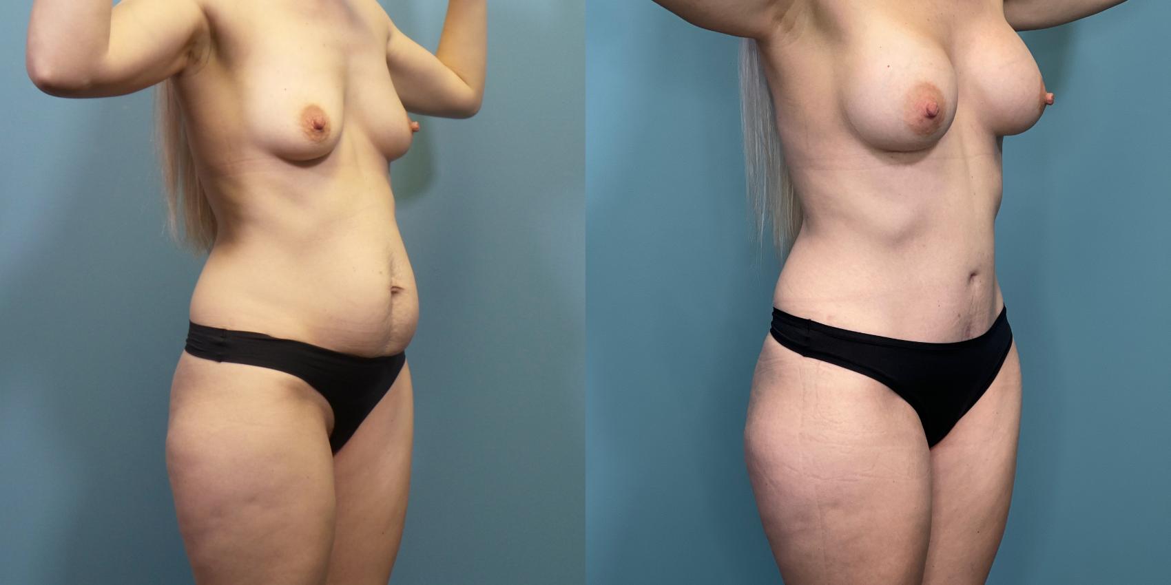 Before & After Tummy Tuck (Abdominoplasty) Case 289 Right Oblique View in Portland, OR