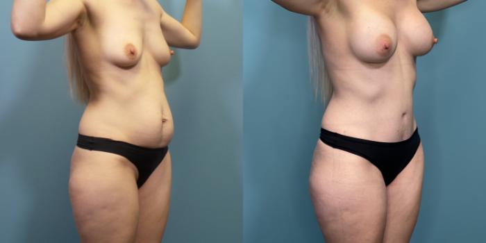 Before & After Tummy Tuck (Abdominoplasty) Case 289 Right Oblique View in Portland, OR