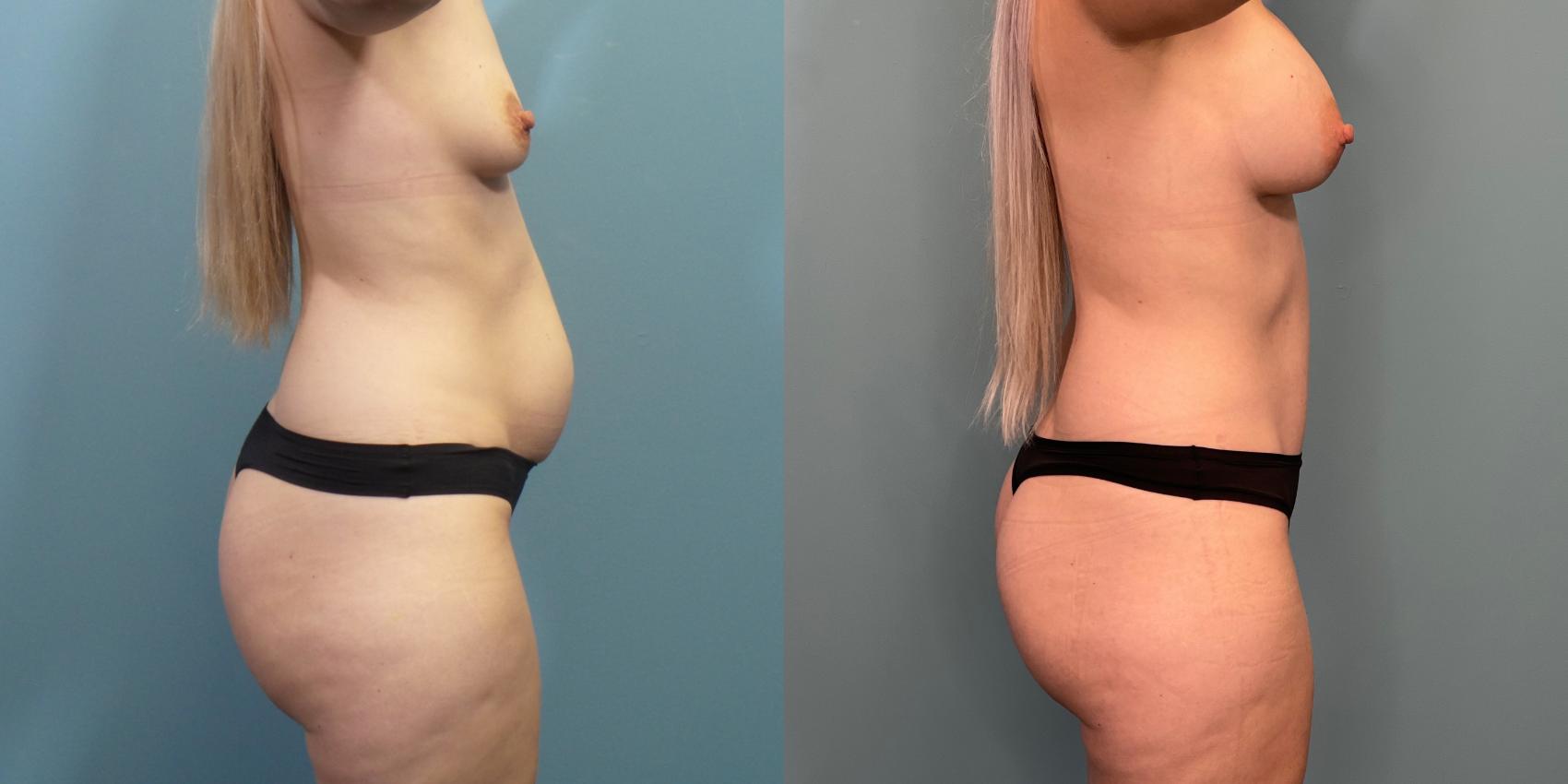 Before & After Tummy Tuck (Abdominoplasty) Case 289 Right Side View in Portland, OR