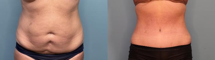 Before & After Tummy Tuck (Abdominoplasty) Case 295 Front View in Portland, OR