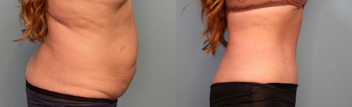 Before & After Tummy Tuck (Abdominoplasty) Case 295 Right Side View in Portland, OR