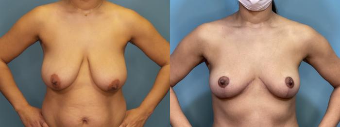 Before & After Mommy Makeover Case 300 Front Breast View in Portland, OR