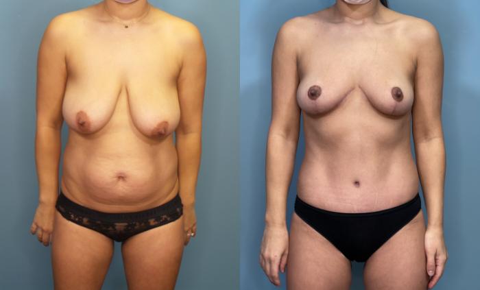 Before & After Tummy Tuck (Abdominoplasty) Case 300 Front View in Portland, OR