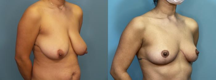 Before & After Tummy Tuck (Abdominoplasty) Case 300 Right Oblique View in Portland, OR