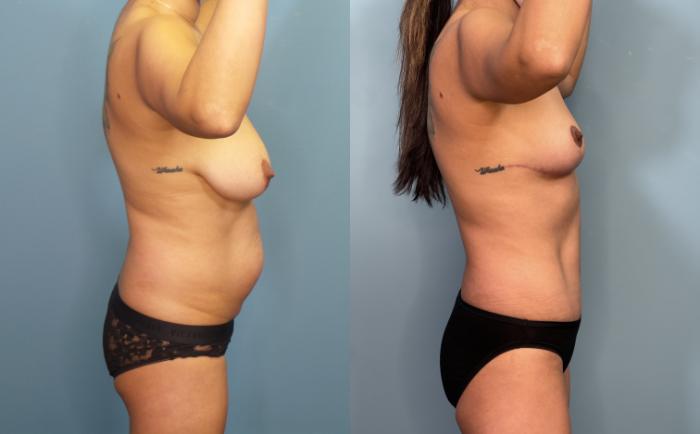 Before & After Tummy Tuck (Abdominoplasty) Case 300 Right Side View in Portland, OR