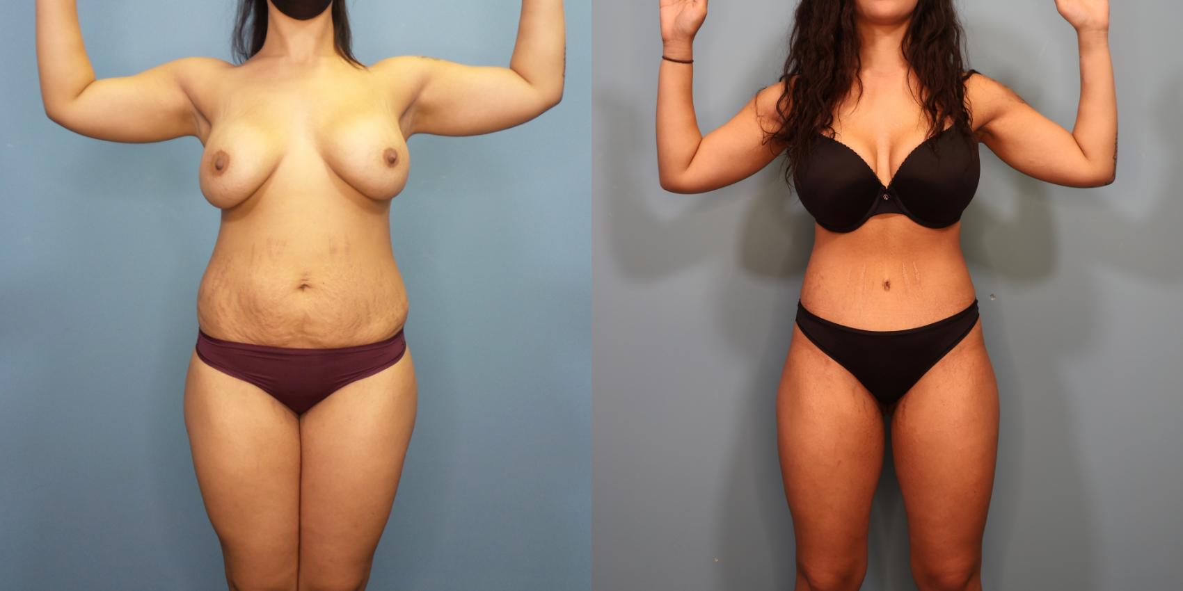 Before & After Tummy Tuck (Abdominoplasty) Case 301 Front View in Portland, OR
