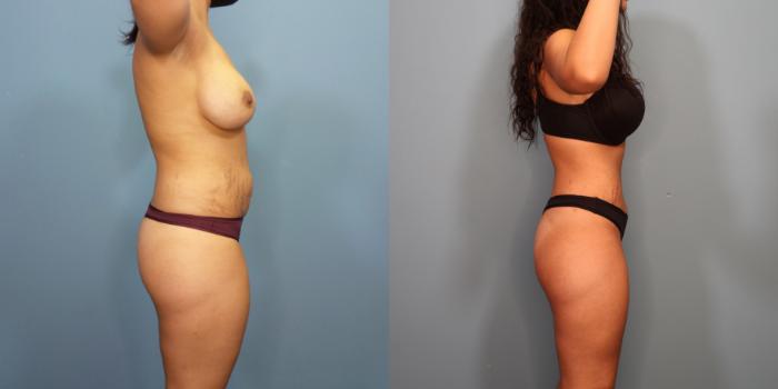 Before & After Tummy Tuck (Abdominoplasty) Case 301 Right Side View in Portland, OR