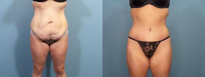 Before & After Tummy Tuck (Abdominoplasty) Case 302 Front View in Portland, OR