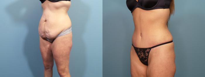 Before & After Tummy Tuck (Abdominoplasty) Case 302 Left Oblique View in Portland, OR