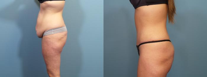 Before & After Tummy Tuck (Abdominoplasty) Case 302 Left Side View in Portland, OR