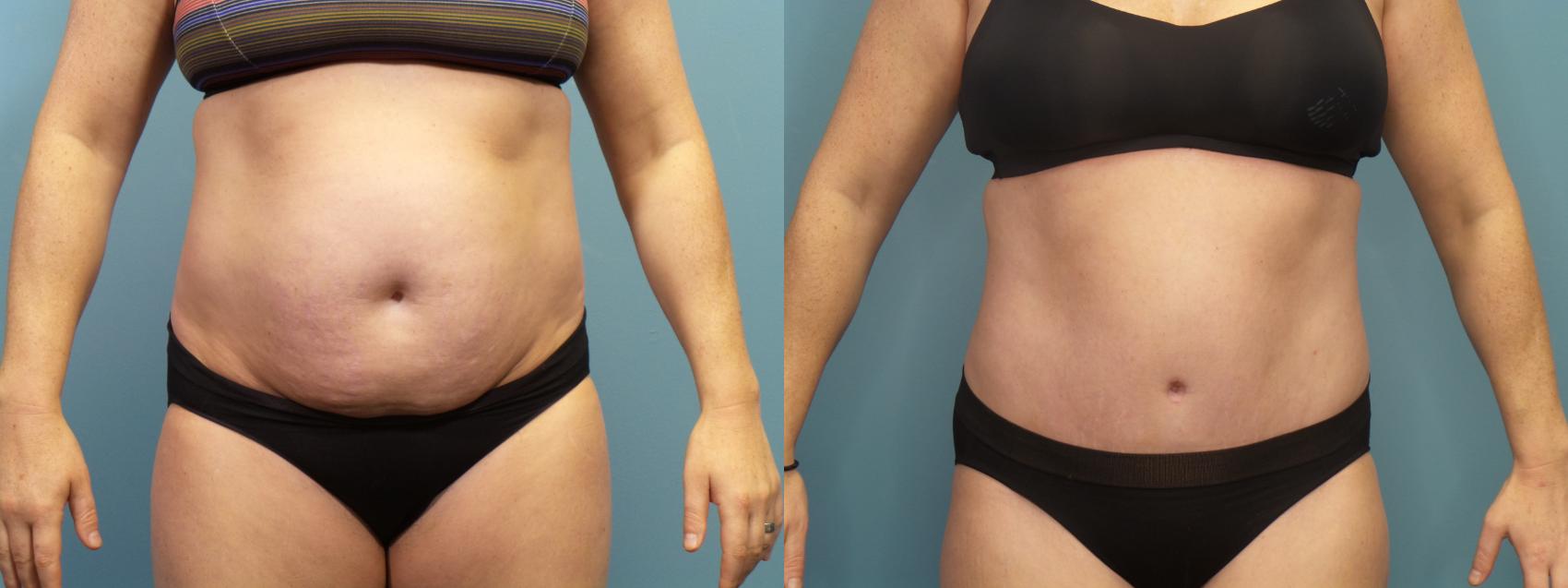 Before & After Tummy Tuck (Abdominoplasty) Case 303 Front View in Portland, OR