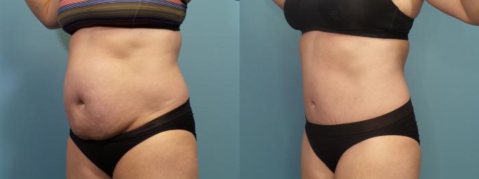 Before & After Tummy Tuck (Abdominoplasty) Case 303 Left Oblique View in Portland, OR