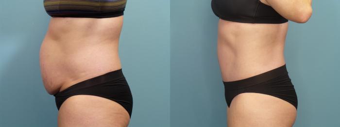 Before & After Tummy Tuck (Abdominoplasty) Case 303 Left Side View in Portland, OR