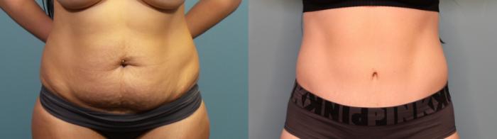 Before & After Tummy Tuck (Abdominoplasty) Case 307 Front View in Portland, OR