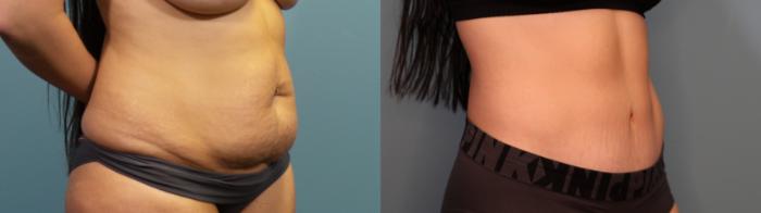 Before & After Tummy Tuck (Abdominoplasty) Case 307 Right Oblique View in Portland, OR