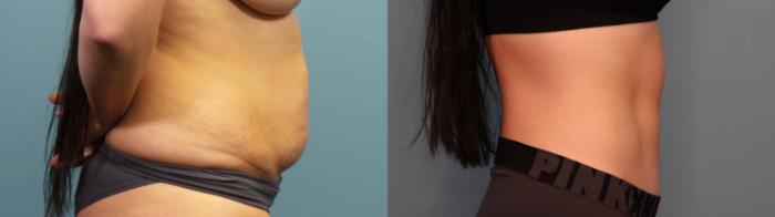 Before & After Tummy Tuck (Abdominoplasty) Case 307 Right Side View in Portland, OR