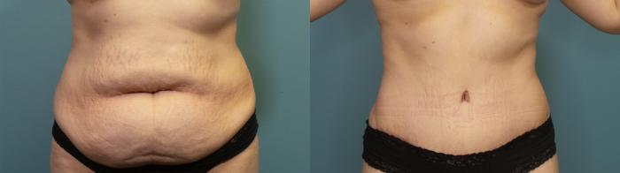 Before & After Tummy Tuck (Abdominoplasty) Case 314 Front View in Portland, OR