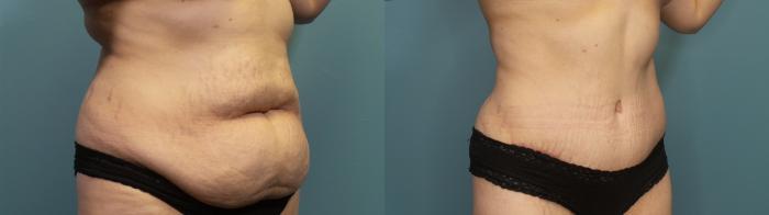 Before & After Tummy Tuck (Abdominoplasty) Case 314 Right Oblique View in Portland, OR