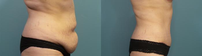 Before & After Tummy Tuck (Abdominoplasty) Case 314 Right Side View in Portland, OR