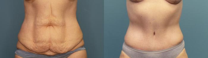Before & After Tummy Tuck (Abdominoplasty) Case 325 Front View in Portland, OR