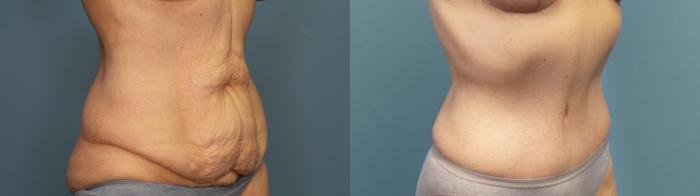 Before & After Tummy Tuck (Abdominoplasty) Case 325 Right Oblique View in Portland, OR