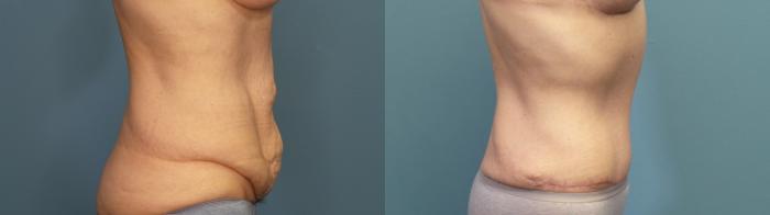 Before & After Tummy Tuck (Abdominoplasty) Case 325 Right Side View in Portland, OR