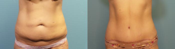 Before & After Tummy Tuck (Abdominoplasty) Case 331 Front View in Portland, OR