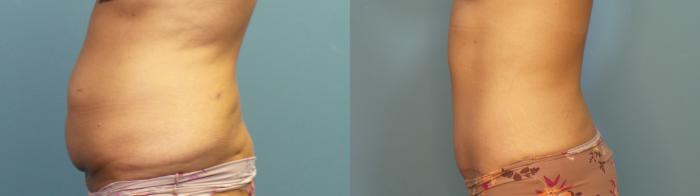 Before & After Tummy Tuck (Abdominoplasty) Case 331 Left Side View in Portland, OR