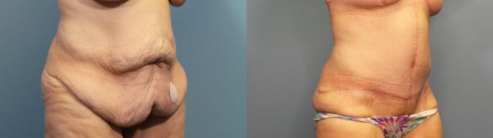 Before & After Tummy Tuck (Abdominoplasty) Case 334 Right Oblique View in Portland, OR