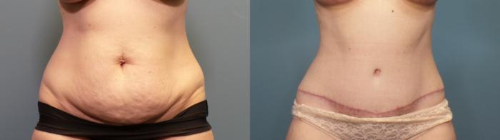 Before & After Tummy Tuck (Abdominoplasty) Case 337 Front View in Portland, OR