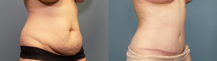 Before & After Tummy Tuck (Abdominoplasty) Case 337 Right Oblique View in Portland, OR