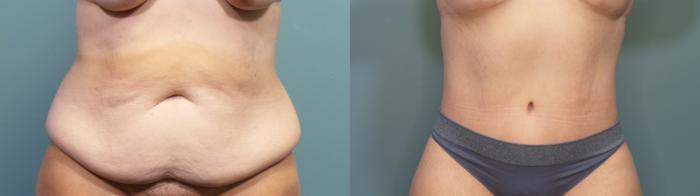 Before & After Massive Weight Loss/Body Lift Case 341 Front View in Portland, OR