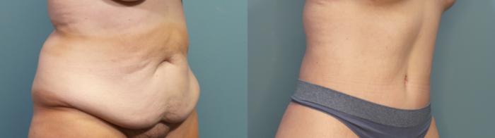 Before & After Massive Weight Loss/Body Lift Case 341 Right Oblique View in Portland, OR