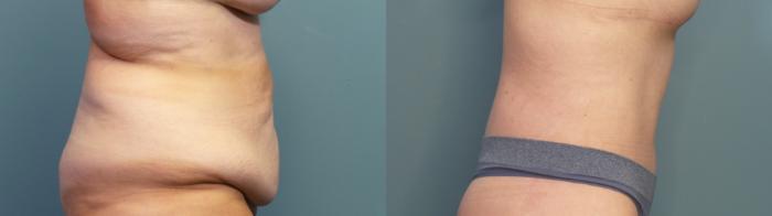 Before & After Tummy Tuck (Abdominoplasty) Case 341 Right Side View in Portland, OR