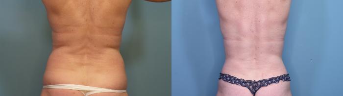 Before & After Tummy Tuck (Abdominoplasty) Case 347 Back View in Portland, OR