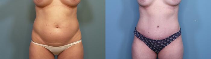 Before & After Liposuction Case 347 Front View in Portland, OR