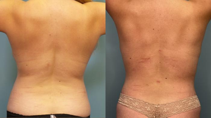 Before & After Liposuction Case 350 Back View in Portland, OR