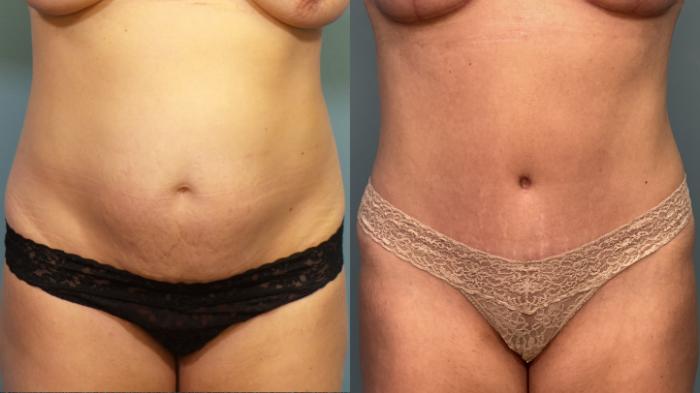 Before & After Tummy Tuck (Abdominoplasty) Case 350 Front View in Portland, OR