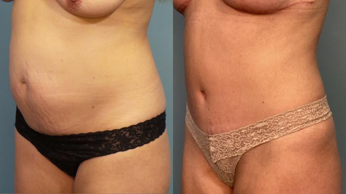 Before & After Liposuction Case 350 Left Oblique View in Portland, OR