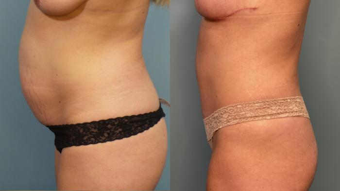 Before & After Tummy Tuck (Abdominoplasty) Case 350 Left Side View in Portland, OR