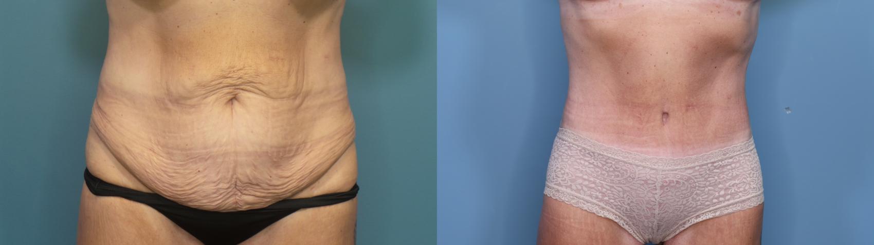 Before & After Tummy Tuck (Abdominoplasty) Case 355 Front View in Portland, OR