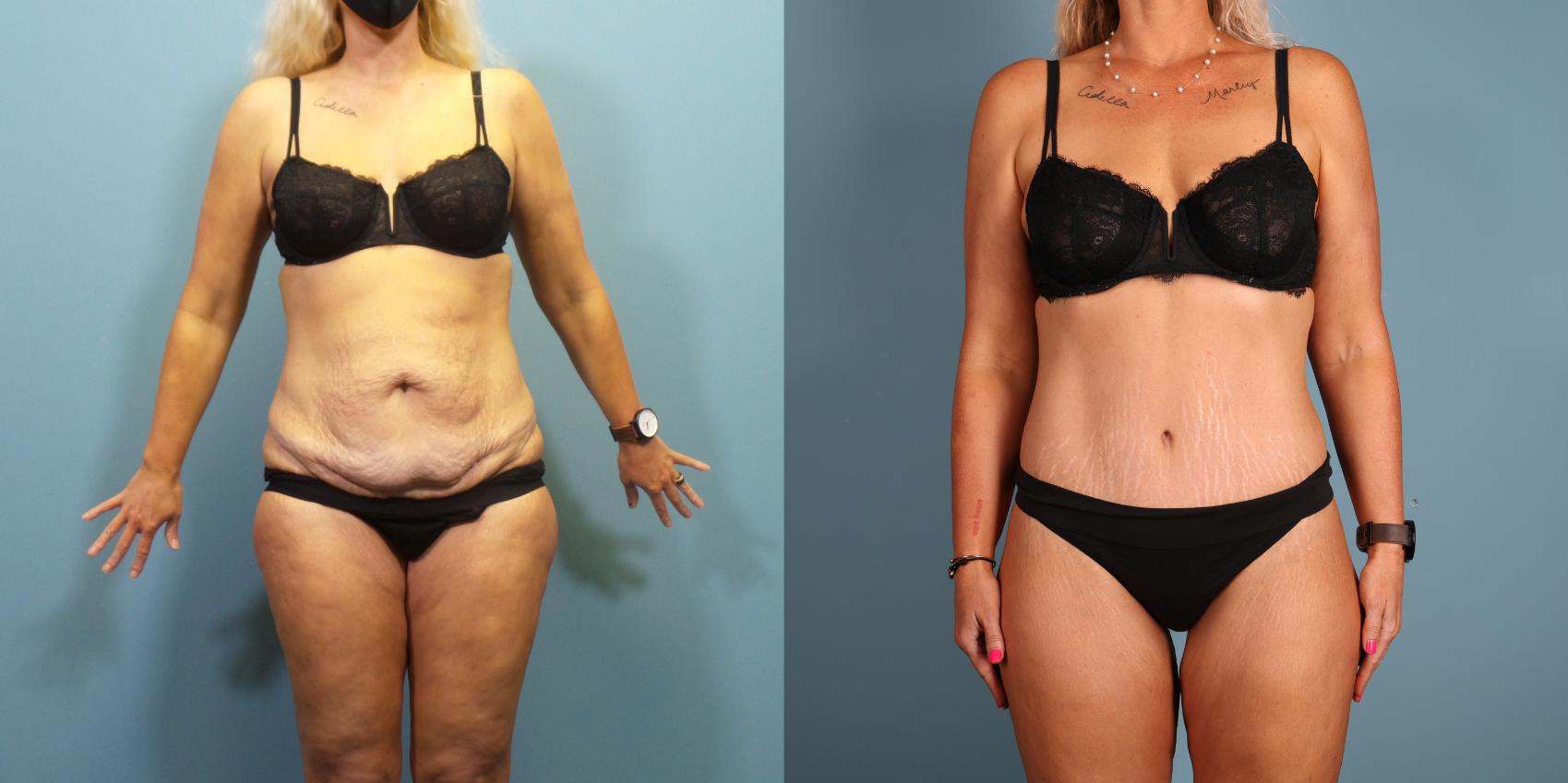 Before & After Massive Weight Loss/Body Lift Case 362 Front View in Portland, OR