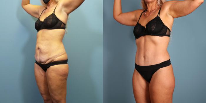 Before & After Massive Weight Loss/Body Lift Case 362 Left Oblique View in Portland, OR