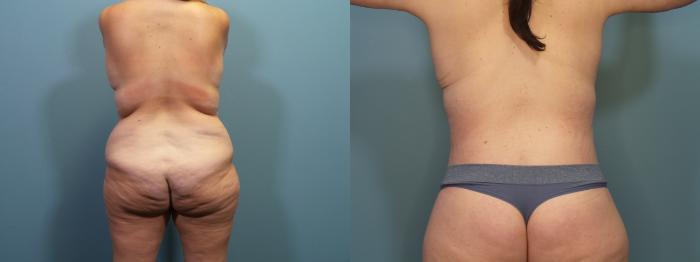 Before & After Tummy Tuck (Abdominoplasty) Case 366 Back View in Portland, OR